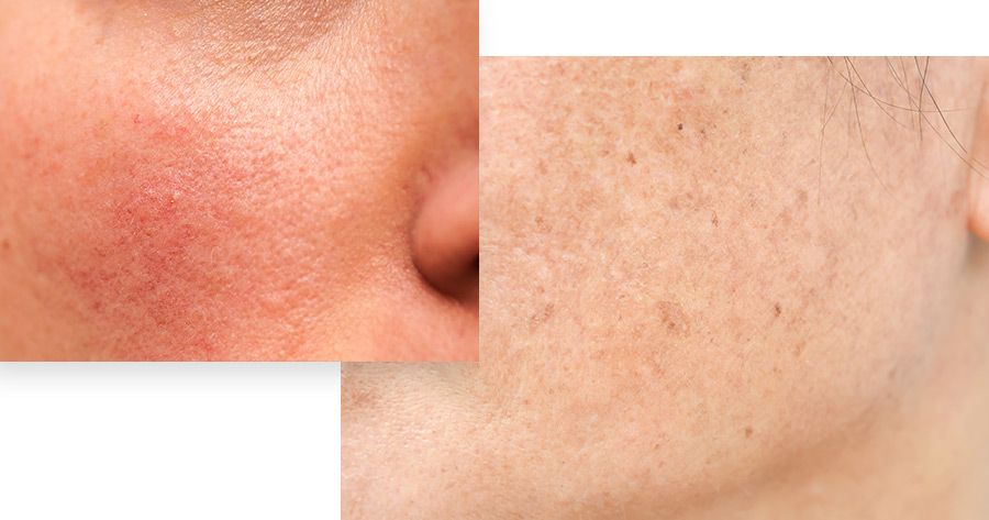 IPL Skin Treatments Using Photo Rejuvenation Service Photo1