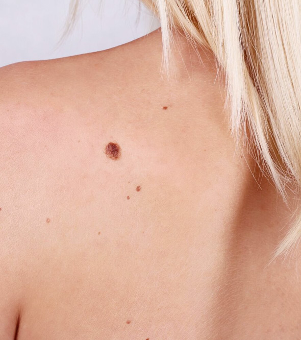 Can Dark Spots be Treated?: Specialists in Dermatology PLLC: Dermatologists