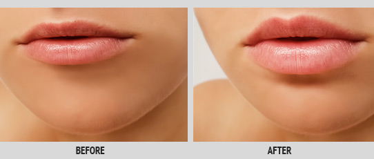 Lip Rejuvenation Service Photo2