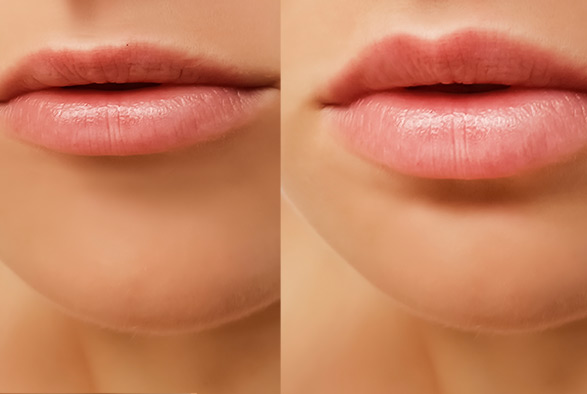 Lip Enhancement Service Photo3