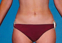 Medial Thigh Lift patient after photo