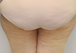 Medial Thigh Lift patient after photo