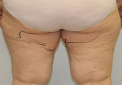 Medial Thigh Lift patient before photo