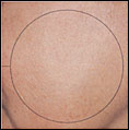 Melasma patient after photo