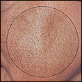 Melasma patient before photo