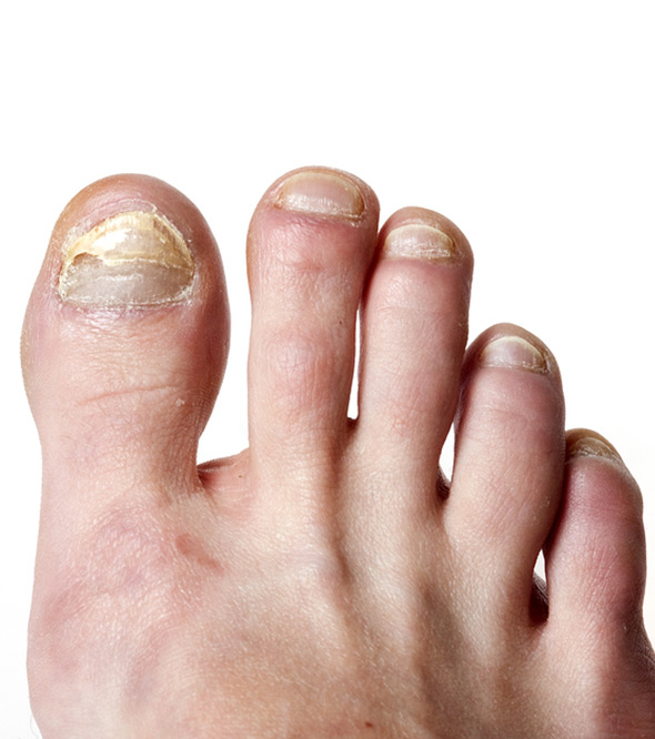 Genesis Laser (Toenail Fungus) Service Photo2