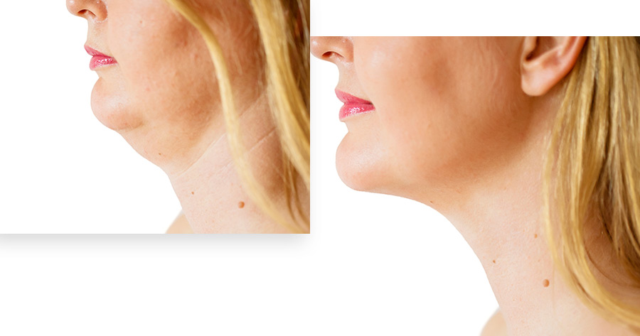 Neck Lift Service Photo1