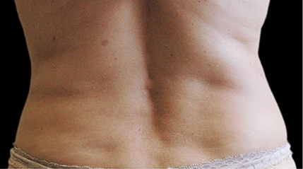 Fat Reduction patient after photo