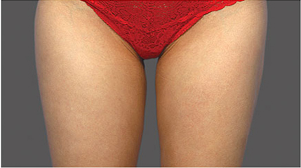Fat Reduction patient after photo