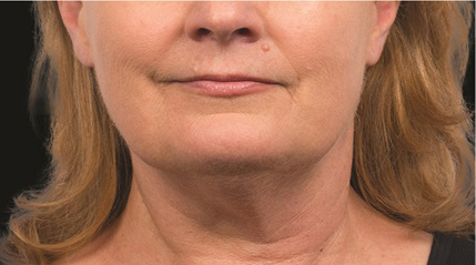 Fat Reduction patient before photo