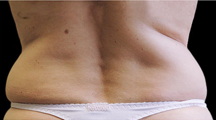 Fat Reduction patient before photo