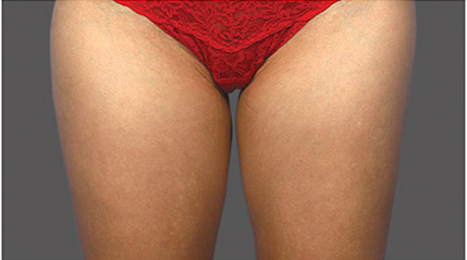 Fat Reduction patient before photo