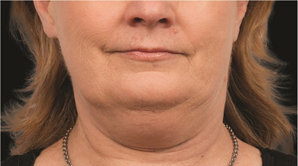 Fat Reduction patient before photo