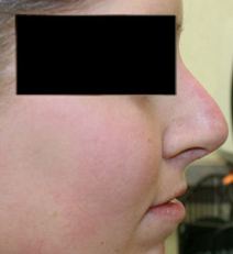 Nose Surgery patient after photo