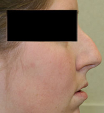 Nose Surgery patient before photo