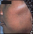 PIGMENTATION patient after photo