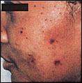 PIGMENTATION patient before photo