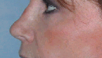 Radiesse patient before photo