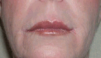 Radiesse patient after photo
