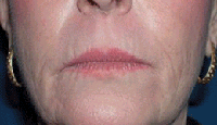 Radiesse patient before photo