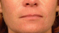 Radiesse patient after photo