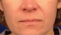 Radiesse patient before photo