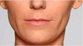 Restylane Defyne after photo