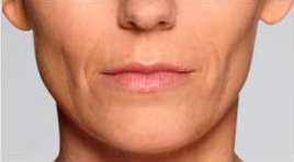 Restylane Defyne patient before photo