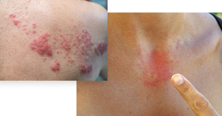 Skin Rash Treatment Nyc Rashes New York