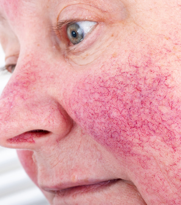 Rosacea Service Photo4