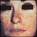 SUN DAMAGE patient before photo
