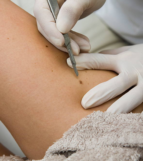 Melanoma, Bellmore, Nassau County Service Photo5