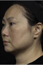 Thermage patient after photo