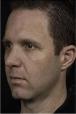Thermage patient after photo