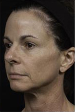 Thermage patient after photo