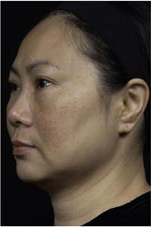 Thermage patient before photo