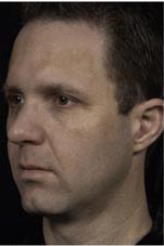 Thermage patient before photo