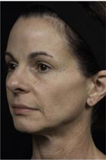 Thermage patient before photo