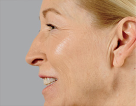 Aging Skin patient after photo