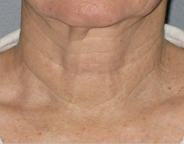 Aging Skin patient after photo