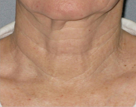 Aging Skin patient after photo