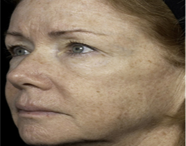 Aging Skin patient after photo