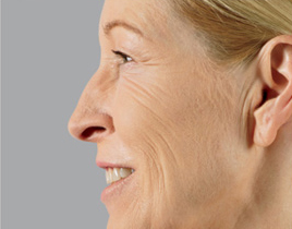 Aging Skin patient before photo
