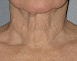 Aging Skin patient before photo