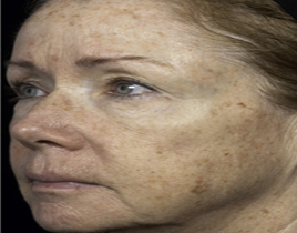 Aging Skin patient before photo
