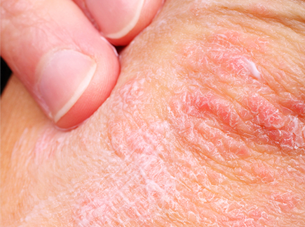 Top Psoriasis Treatments in Tribeca, Manhattan Service Photo1