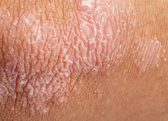 Top Psoriasis Treatments in Tribeca, Manhattan Service Photo2