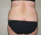 Bella Contour patient after photo