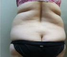 Bella Contour patient before photo
