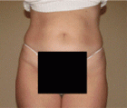 Bella Contour patient before photo
